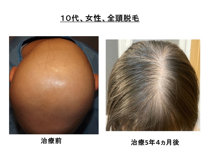 円形脱毛症　病院